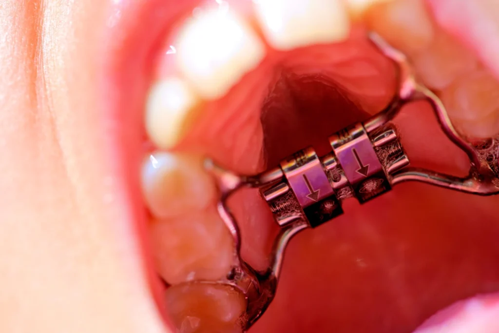 Orthodontiste enfants - Disjoncteur - Meylan 38240, Orthodontiste Domène, Orthodontiste Corenc, Orthodontiste Saint-Nazaire-les-Eymes