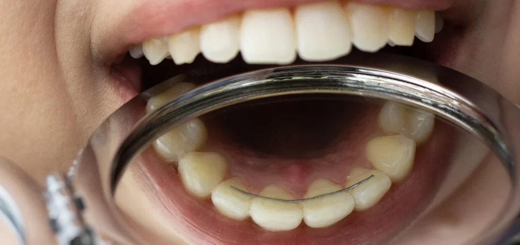 Orthodontiste Meylan - La contention