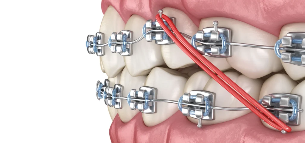 élastiques Orthodontiste Meylan 38240