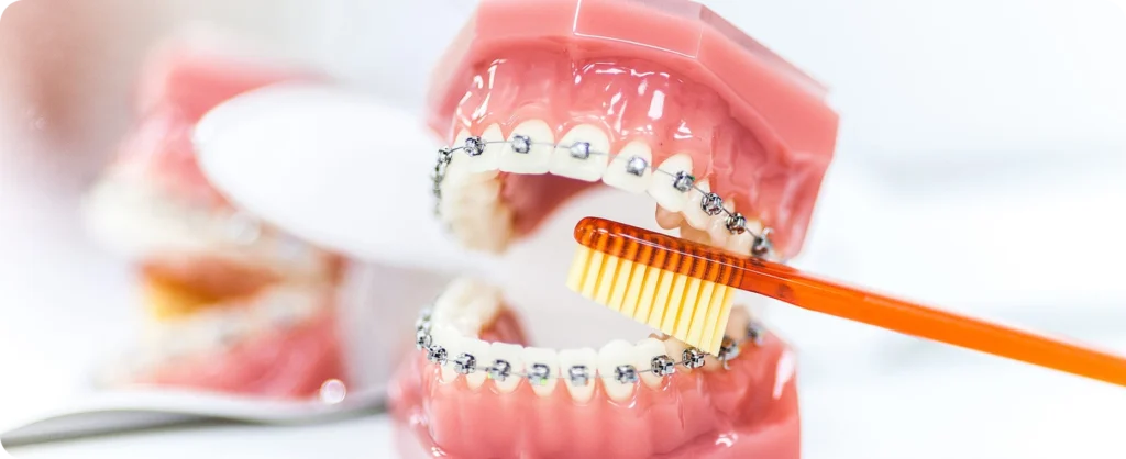 Orthodontie à Saint-Ismier, Orthodontiste Saint-Ismier