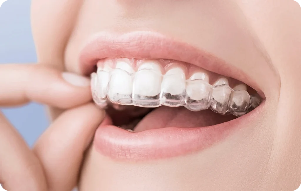 Orthodontiste Meylan, Orthodontiste La Tronche, Orthodontiste Saint-Ismier,  Orthodontiste Grenoble