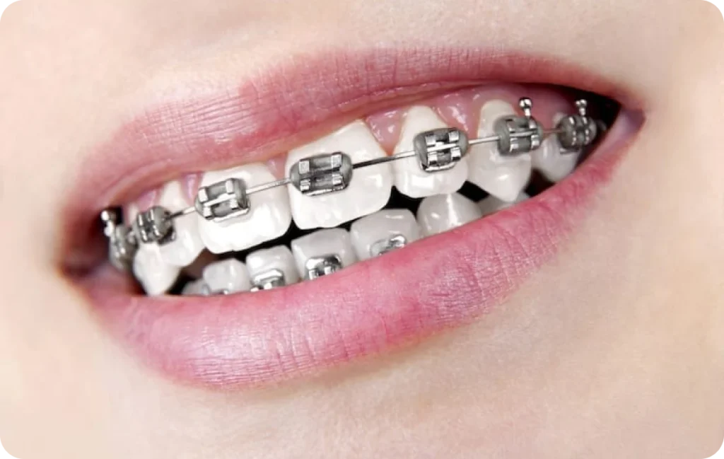 Orthodontie à Grenoble, Orthodontiste Grenoble